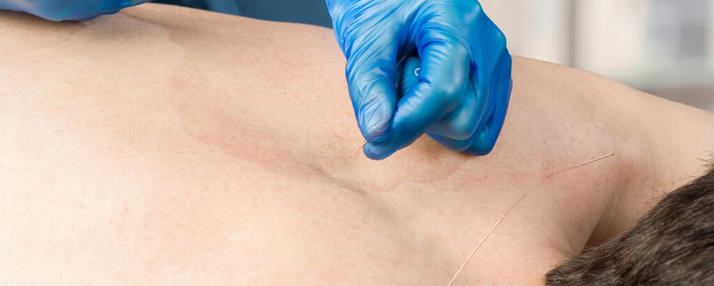 Dry Needling